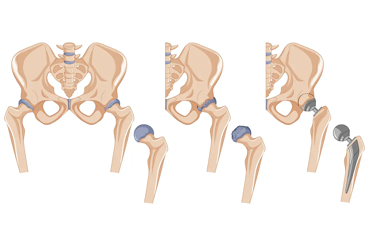 cirurgia de prótese de quadril