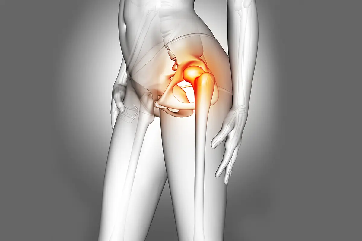 osteonecrose da cabeça femoral