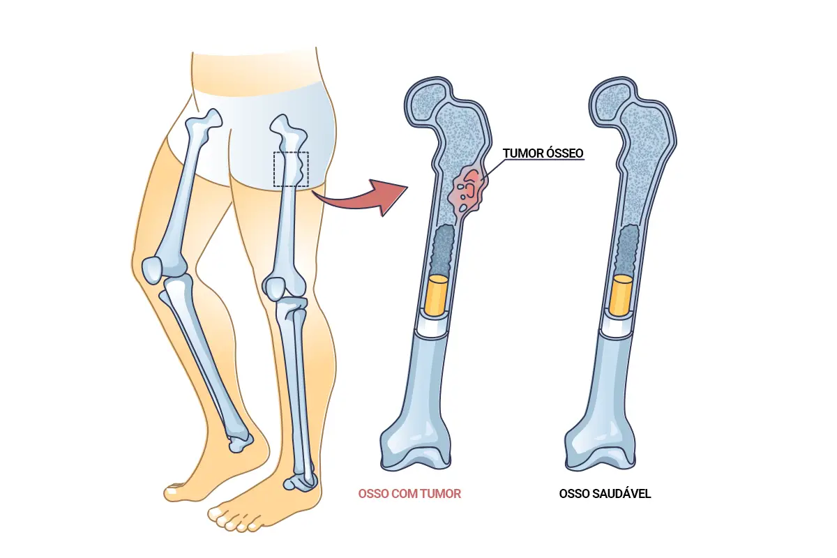 tumor ósseo