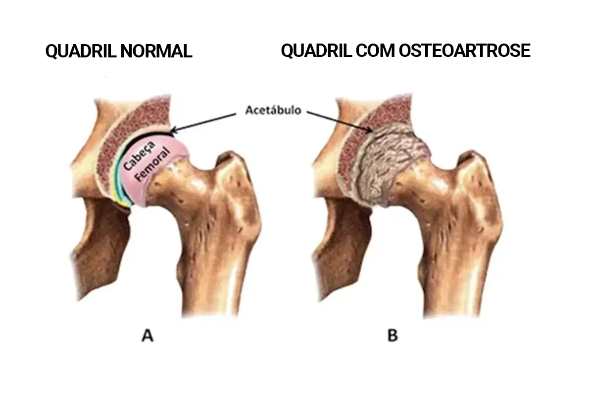 osteoartrose de quadril